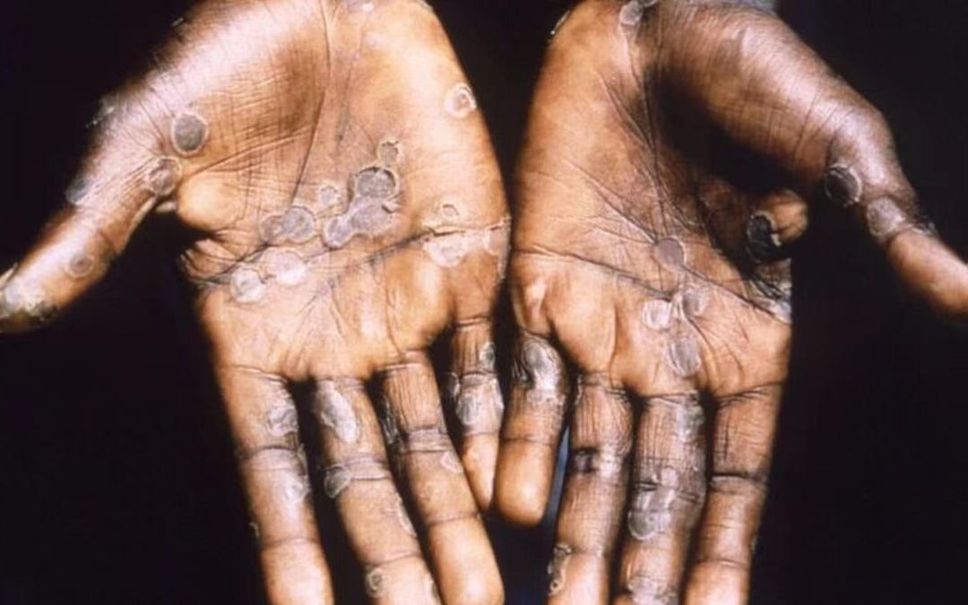 Risk assessment Monkeypox multi-country outbreak