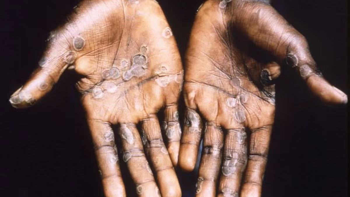 Risk assessment Monkeypox multi-country outbreak